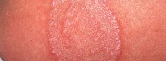 how to kill ringworm